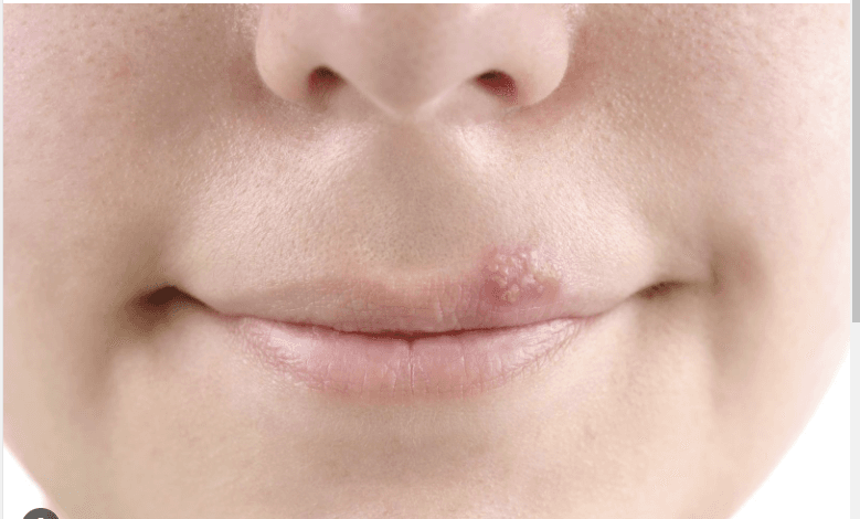 causes-of-mouth-sores-and-their-solutionscauses-of-mouth-sores-and-their-solutions